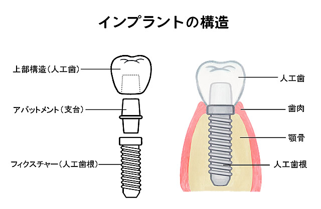 インプラント構造