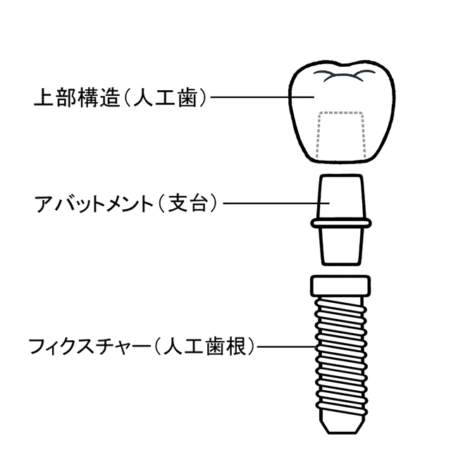 インプラント